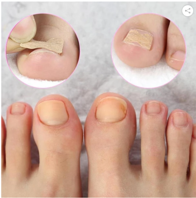 Toenail Corrector Patch